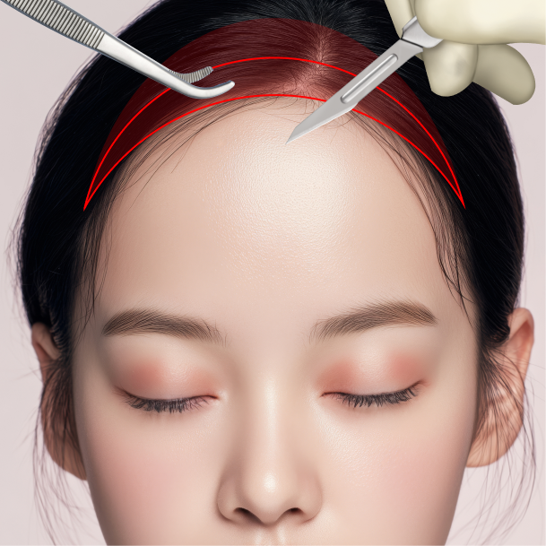 이마축소술 수술방법 02