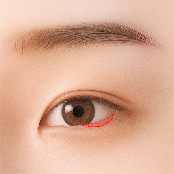 밑트임 수술방법 02