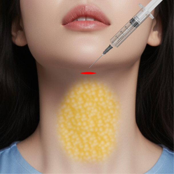 이중턱근육묶기 수술방법 02