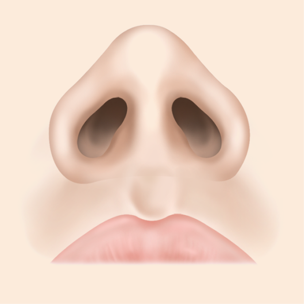 콧볼축소술 내측절개 수술방법 04