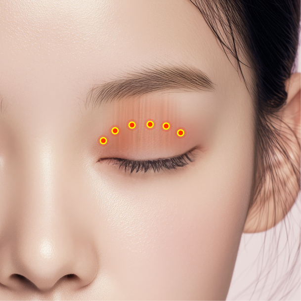 눈매교정 수술방법 03