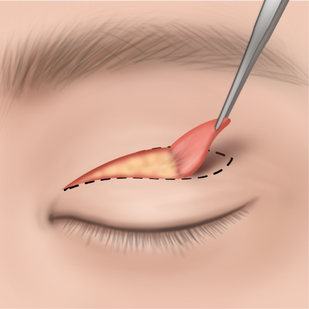 상안검 수술방법 02