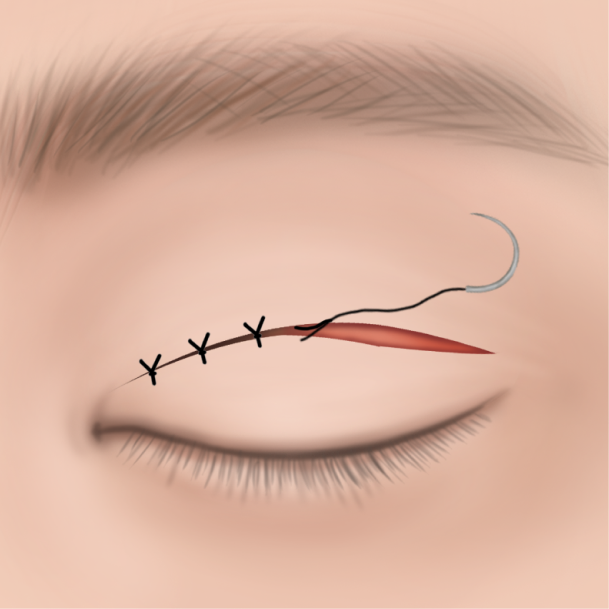 상안검 수술방법 04