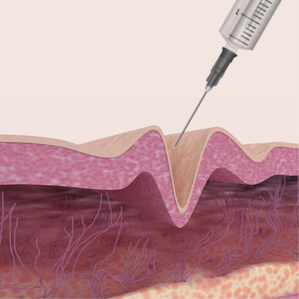 부산보톡스/필러 시술방법 02