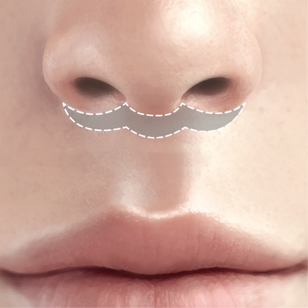 인중축소술 수술방법 03