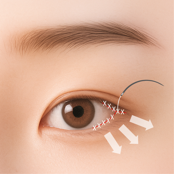 듀얼트임 수술방법 03