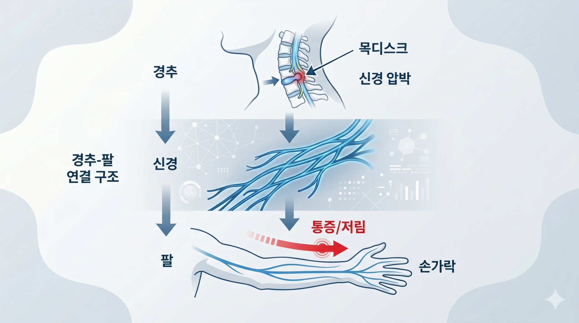 경추 신경 압박으로 발생하는 손가락 저림 구조
