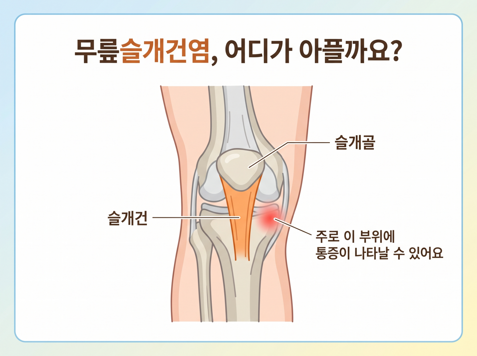 무릎슬개건염에서 통증이 나타날 수 있는 슬개골 아래 슬개건 위치