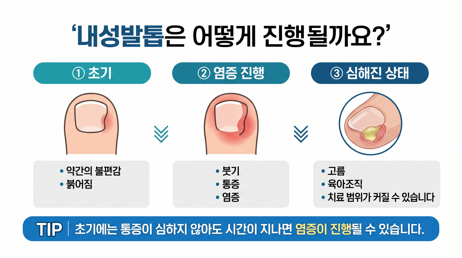 내성발톱 초기부터 염증과 고름까지 진행 단계를 설명하는 인포그래픽