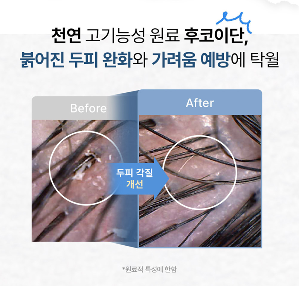 민감성 두피 토버스 샴푸바 - 가려움예방효능