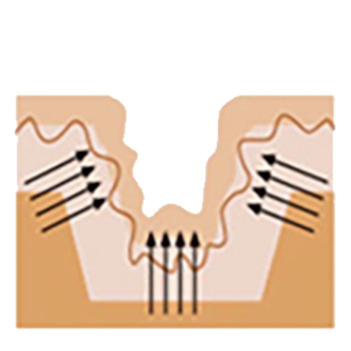 새살재생 촉진 치료