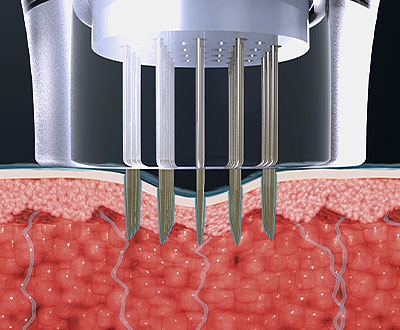 침습형 고주파 작동 원리