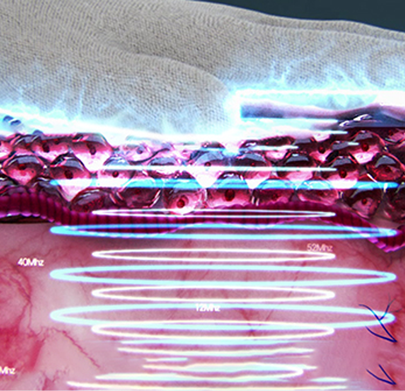 스킨 글로브 핸드피스