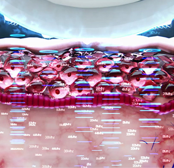 스킨 롤러 핸드피스