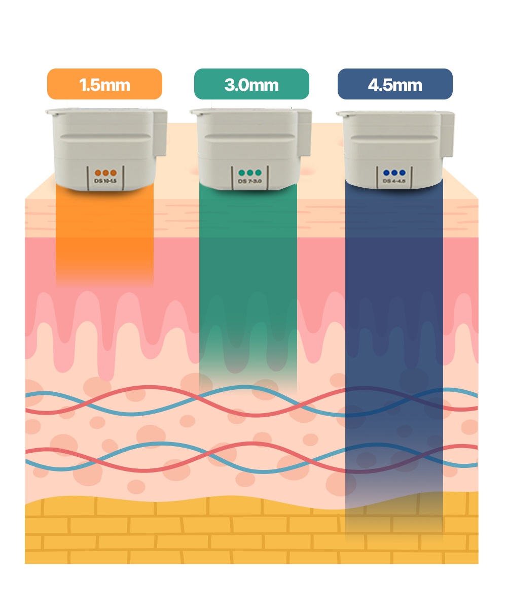 커스터마이징 시술