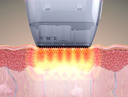 비침습형 고주파 작동 원리