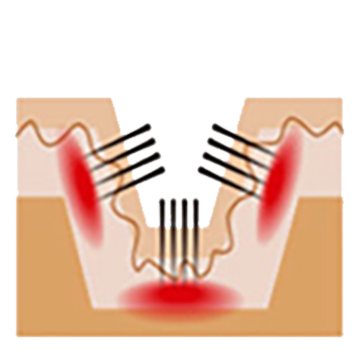 흉터 부위에 진피층 자극