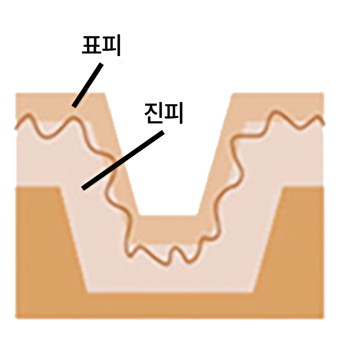 박스형 패인 흉터