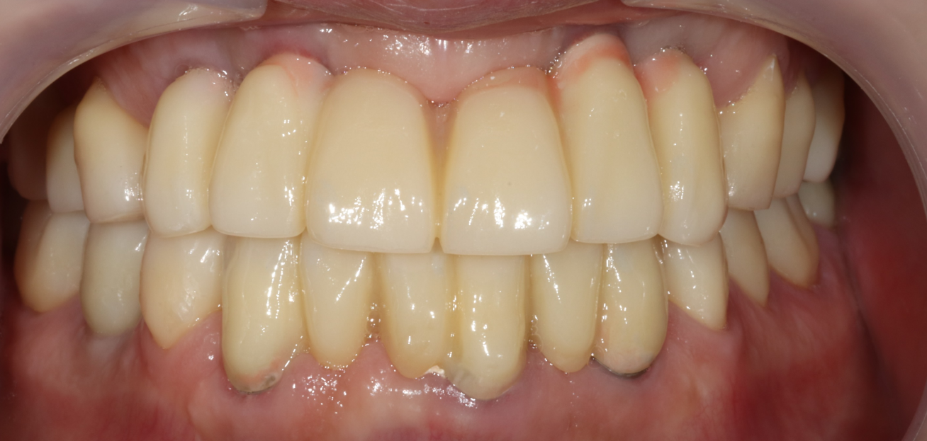 After