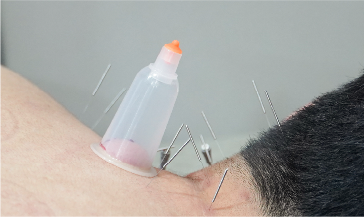 건식/습식 부항