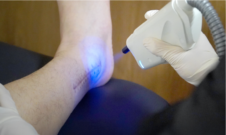 크라이오테라피