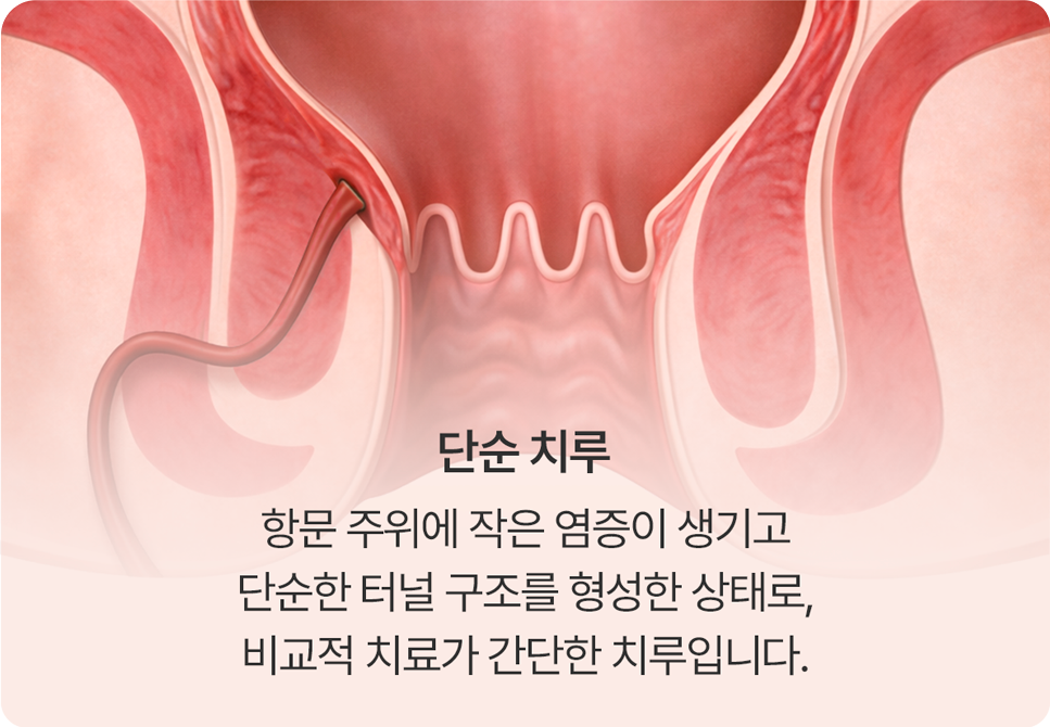 단순치루