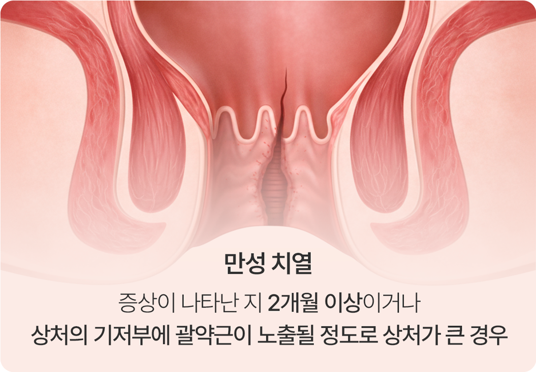 만성 치열