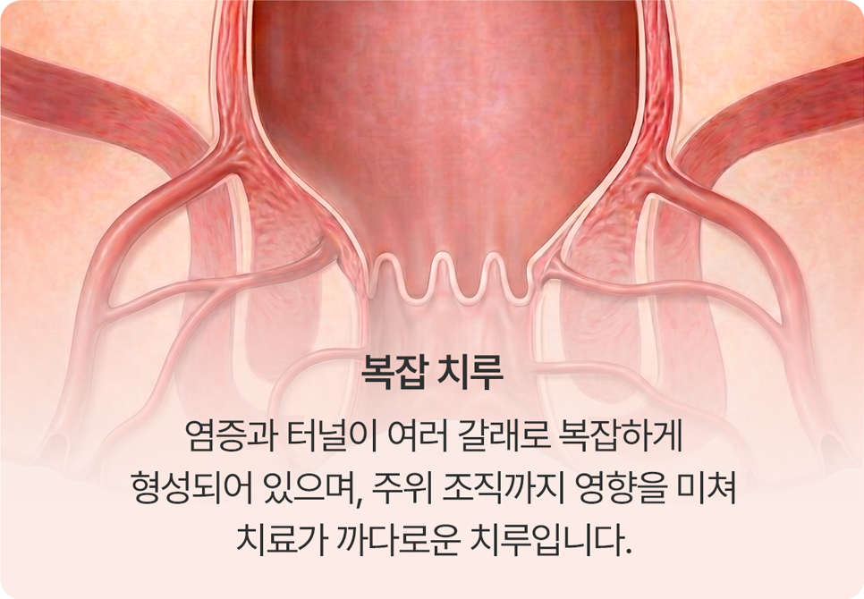 복잡치루
