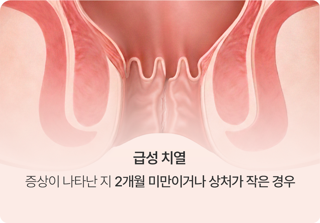 급성 치열