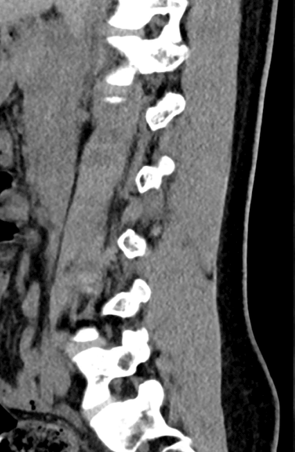 CT Scan