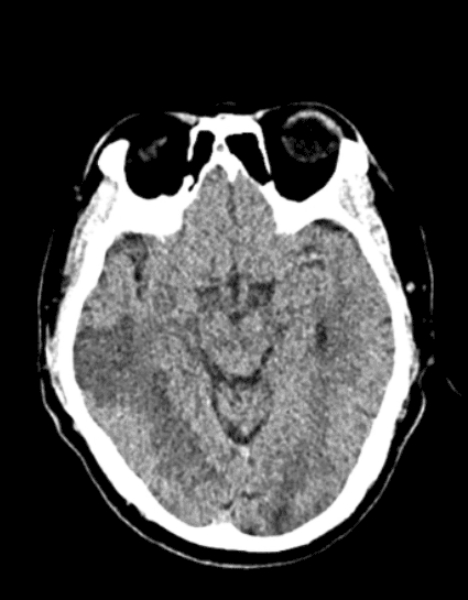 CT Scan