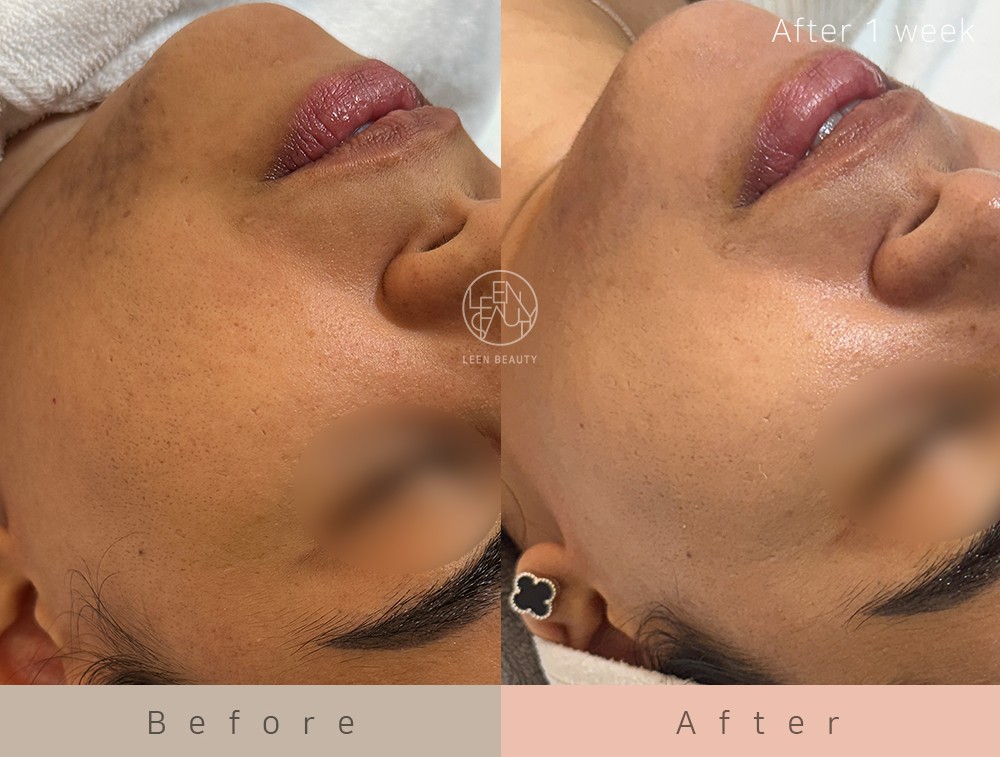 Permatology Microneedling