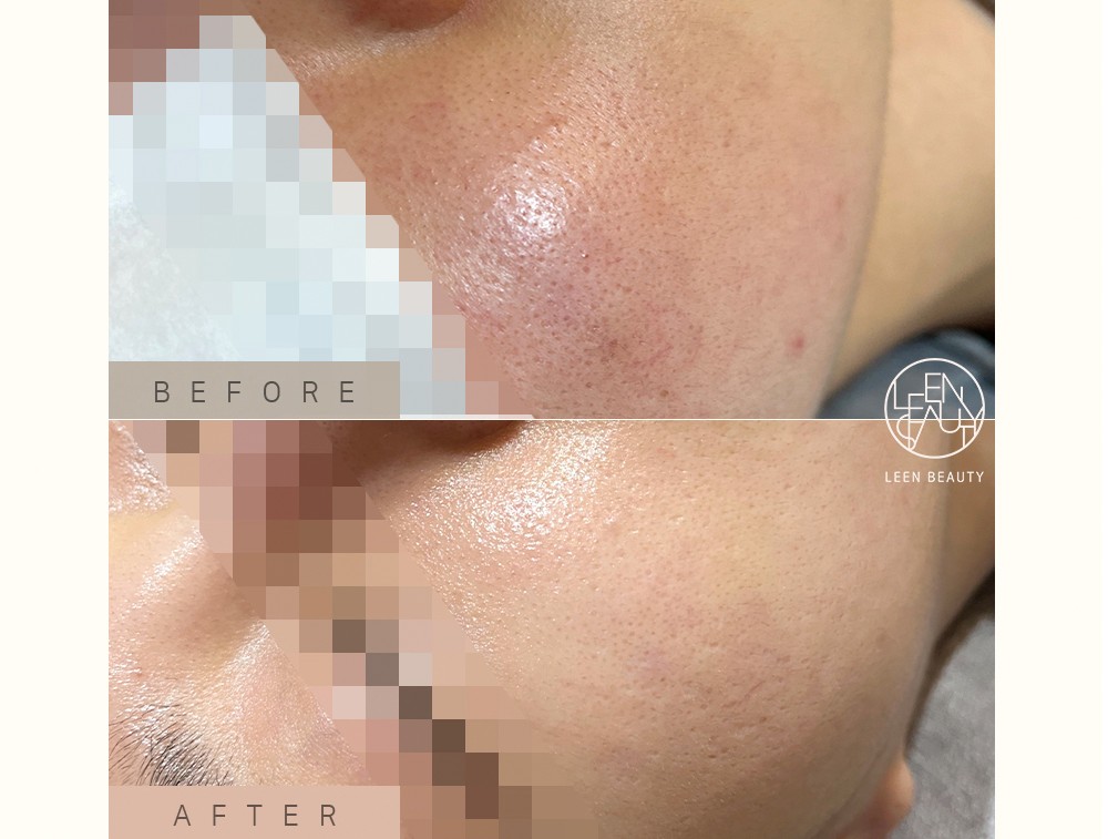 Permatology Microneedling