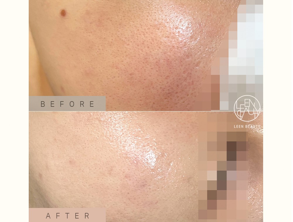 Permatology Microneedling