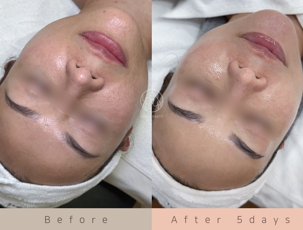 Permatology Glass Skin Treatment