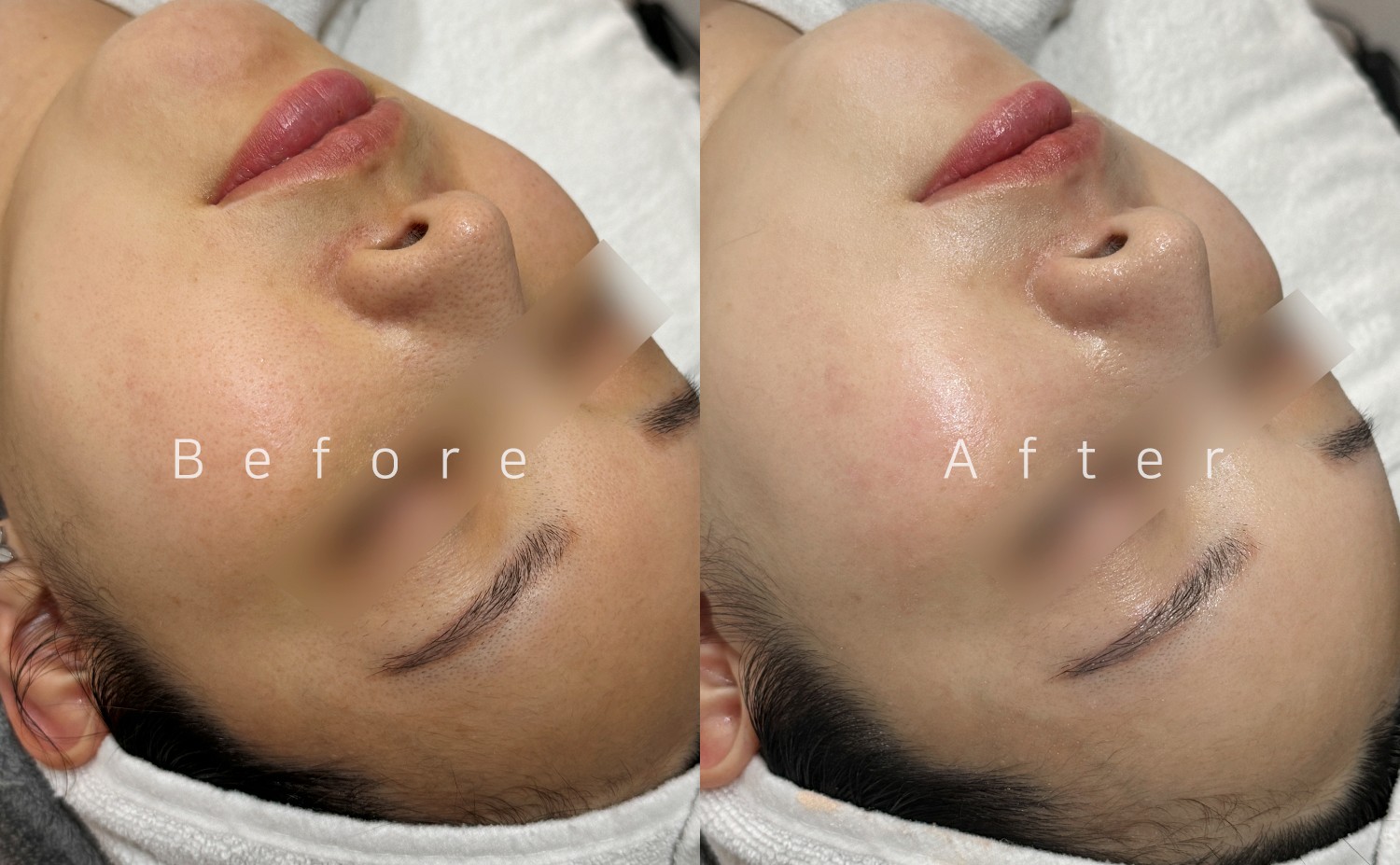 PDRN Glow Brightening Treatment