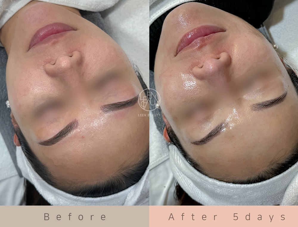 Permatology Glass Skin Treatment