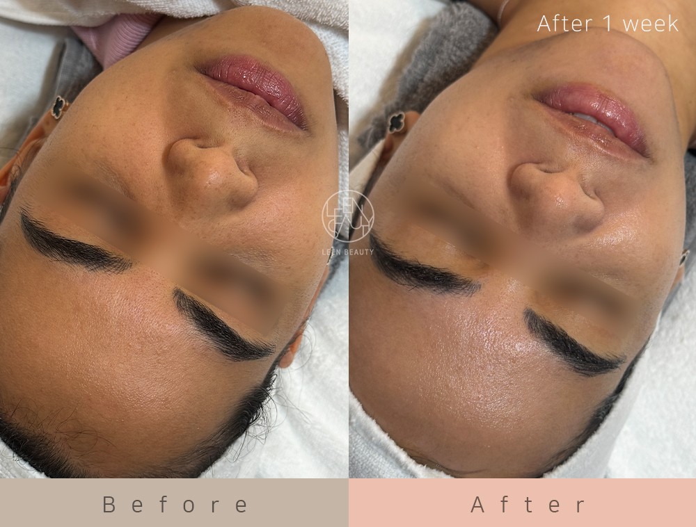 Permatology Microneedling