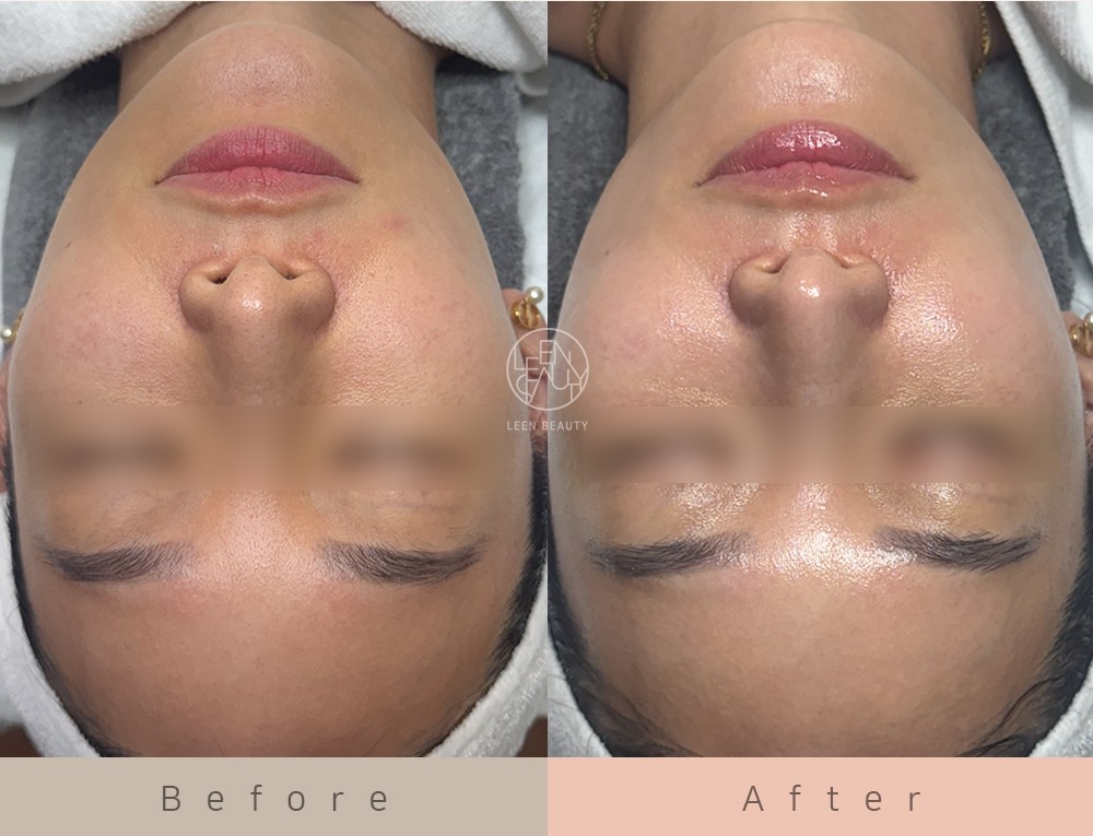 Permatology Glass Skin Treatment
