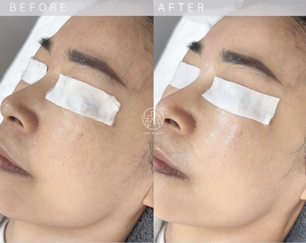 Permatology Glass Skin Treatment