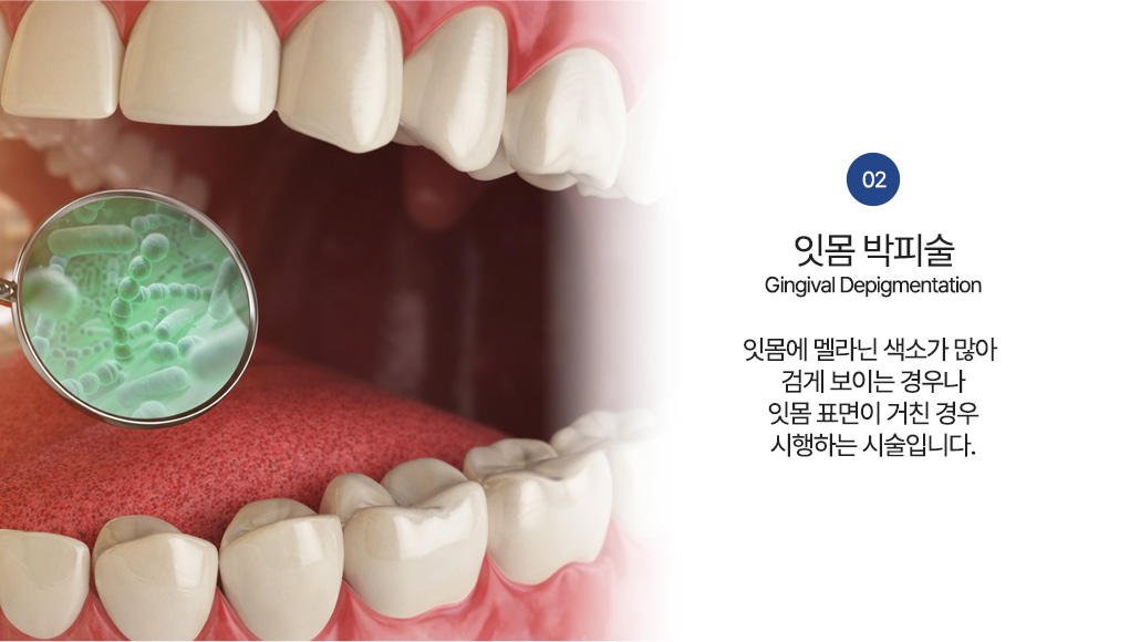 잇몸 박피술