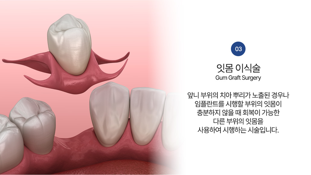잇몸 이식술