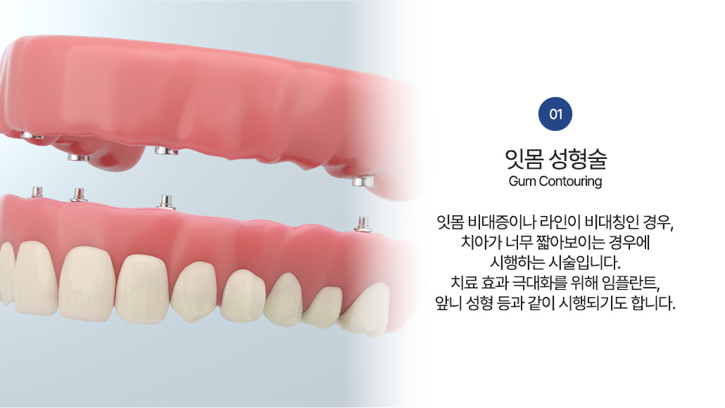 잇몸 성형술