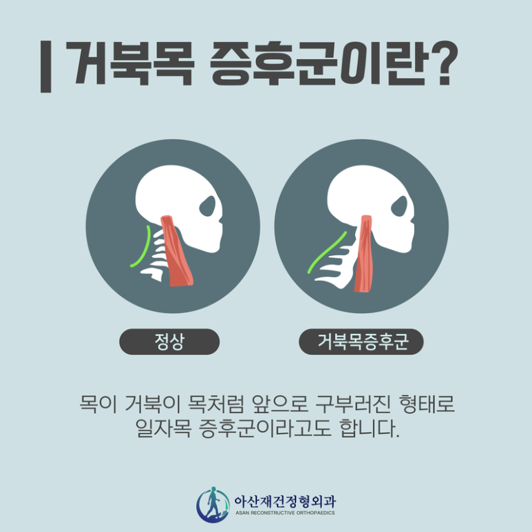 양주거북목증후군, 양주거북목증후근교정, 양주체형교정클리닉, 양주측만증교정센터, 양주평발깔창
