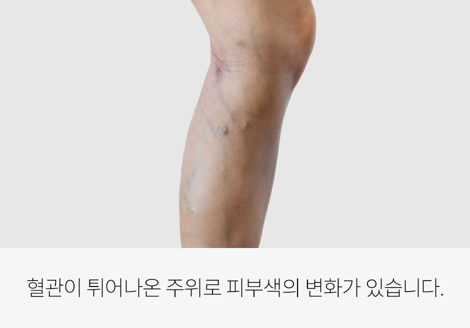 증상 이미지 2