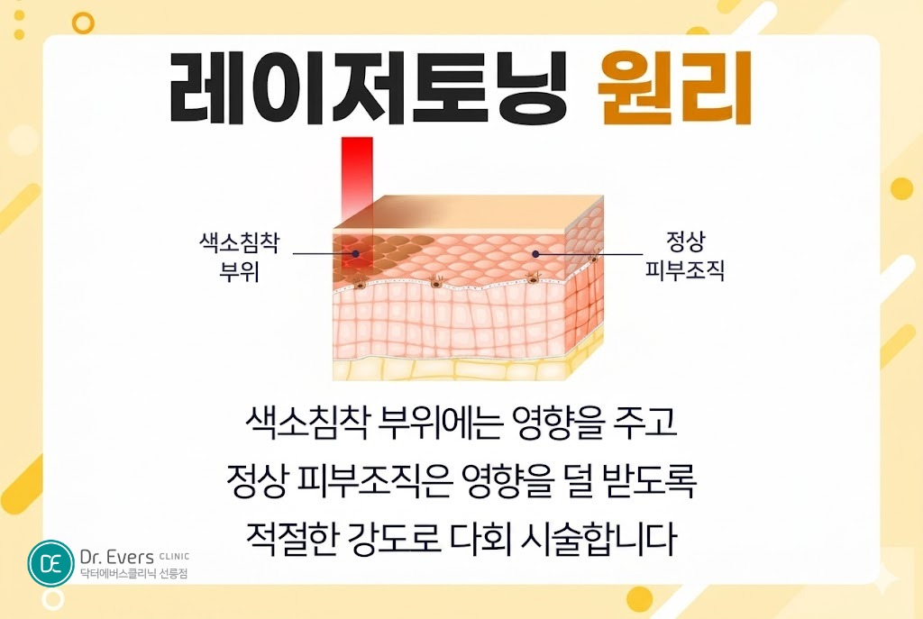 레이저토닝 효과 겨드랑이 착색 까만 팔꿈치 다리 색소침착 개선_선릉피부과 닥터에버스의원 선릉점