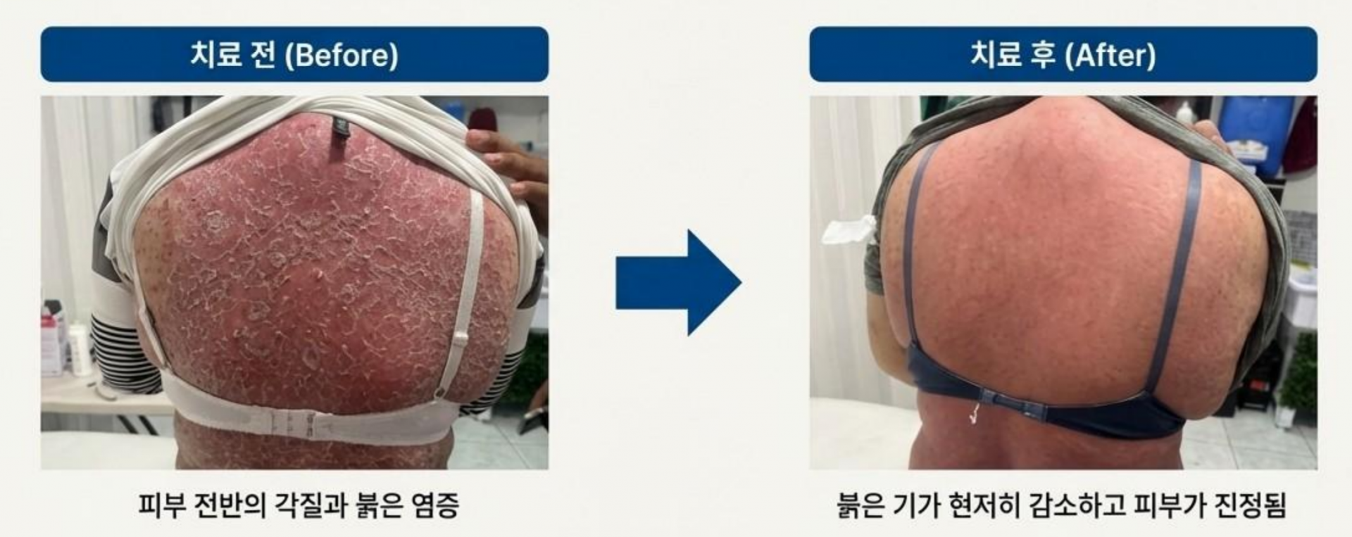 민감성피부.png