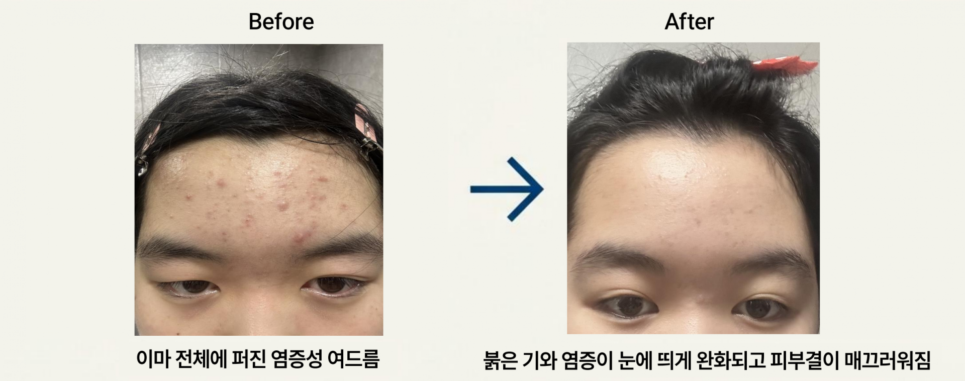 여드름사례.png