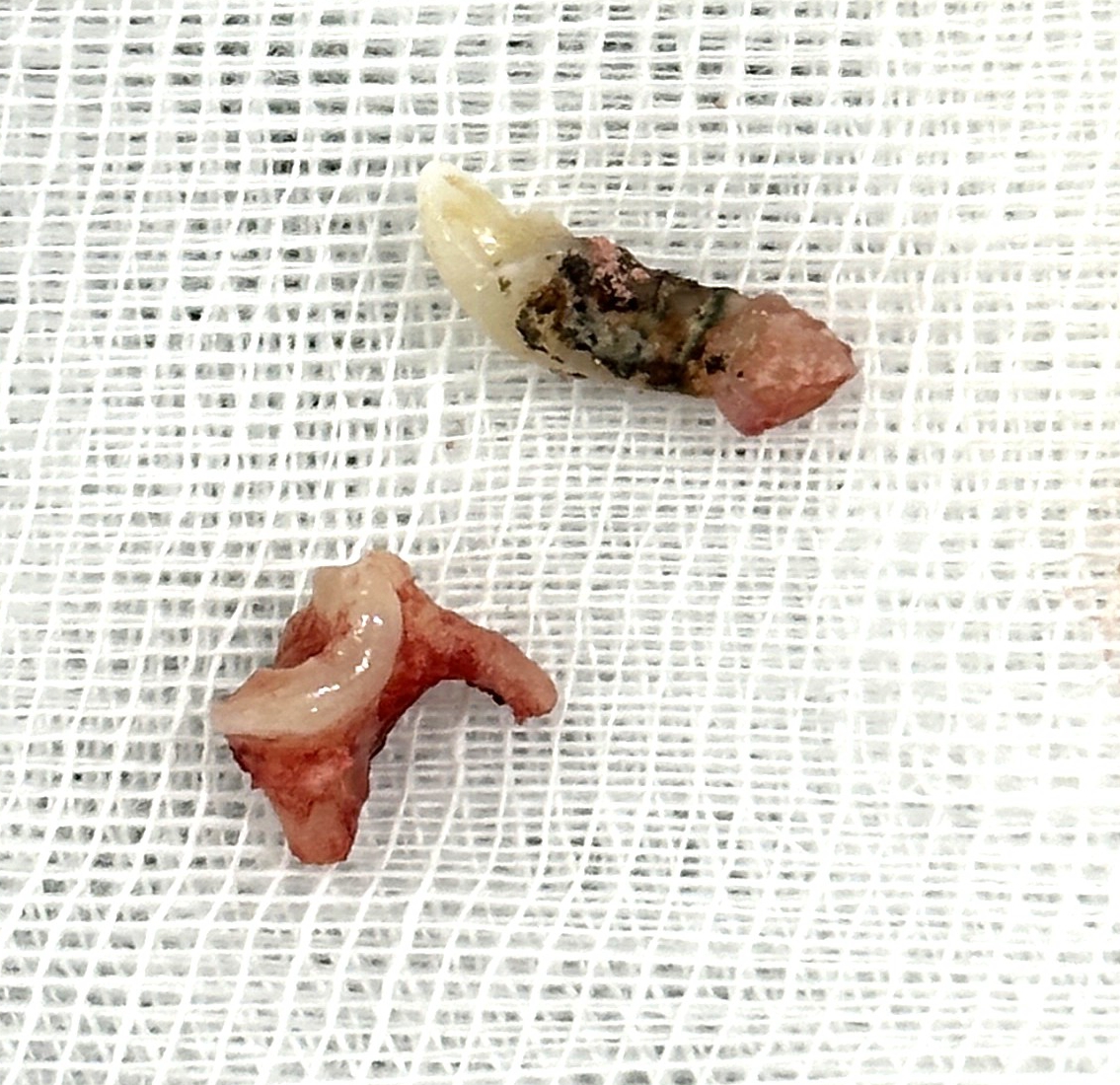 치은연하 치석 설명 자료