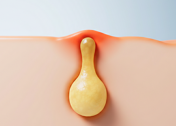 피부종양